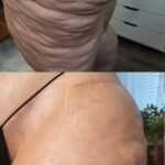 Cellulite Treatment