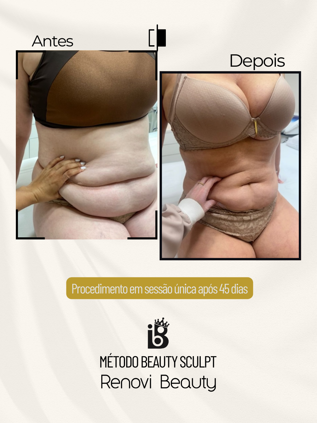 Resultados Beauty Sculpt