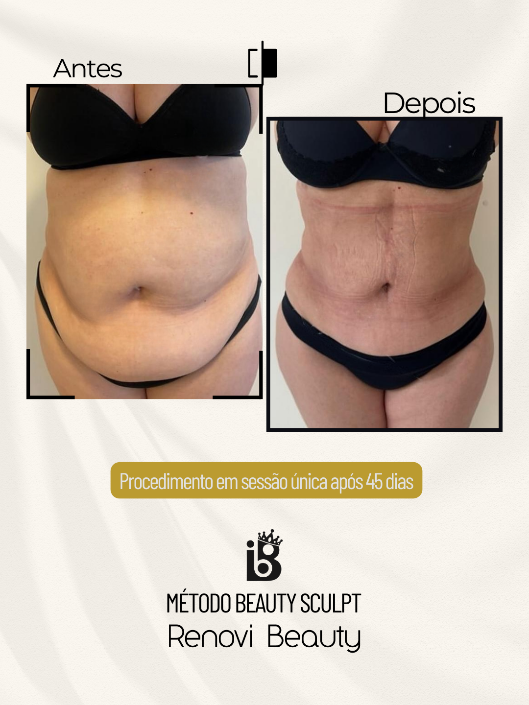 Resultados Beauty Sculpt