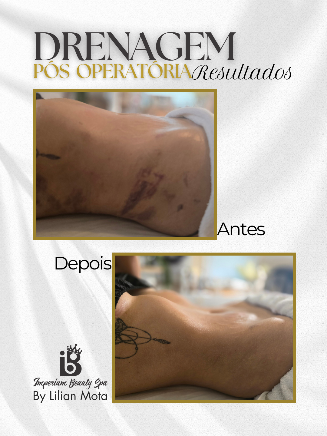 Resultado Drenagem Pós-Operatória