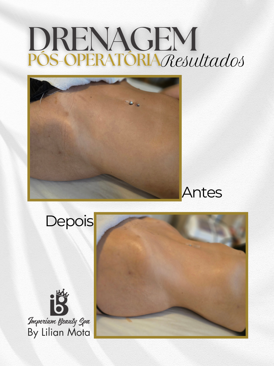 Resultado Drenagem Pós-Operatória